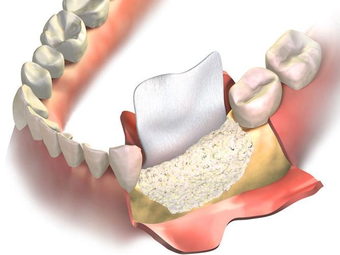 Dentalna Hirurgija Smile Esthetics Korekcije koštanog i mekog tkiva