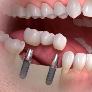 implant-borne_multi-tooth_treatment_03 Stomatoloska ordinacija Beograd