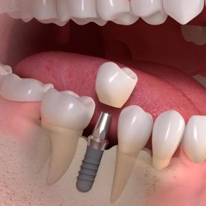 implant-borne_single-tooth_treatment_03 Stomatoloska ordinacija Beograd