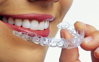 ortodoncija glavna 1 - invisalign Stomatoloska ordinacija Beograd