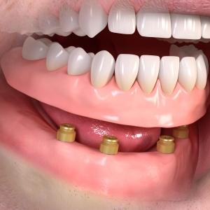 removable_denture_with_lxxx_attachement_03 Stomatoloska ordinacija Beograd
